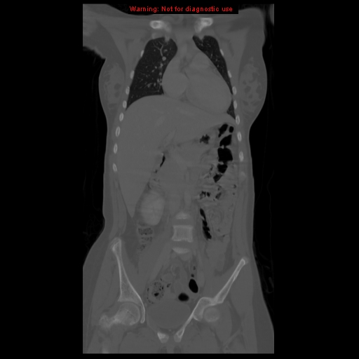 File:Brown tumor (Radiopaedia 12318-12596 D 28).jpg