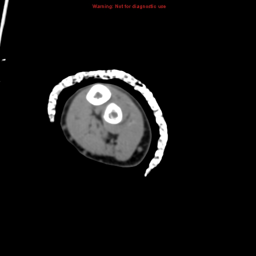 Brown tumor (Radiopaedia 12460-12694 Axial non-contrast 116).jpg