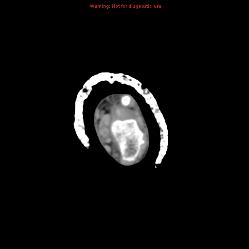 File:Brown tumor (Radiopaedia 12460-12694 Axial non-contrast 18).jpg