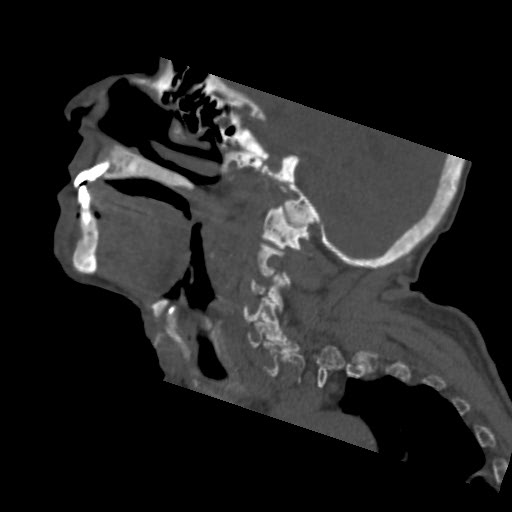 File:Brown tumor with secondary hyperparathyroidism (Radiopaedia 23591-23705 B 7).jpg