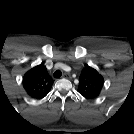 Buccal fat pad arteriovenous malformation (Radiopaedia 70936-81144 A 102).jpg