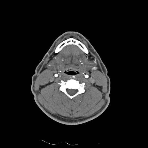 Buccal fat pad arteriovenous malformation (Radiopaedia 70936-81144 D 143).jpg