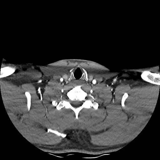 Buccal fat pad arteriovenous malformation (Radiopaedia 70936-81144 D 74).jpg