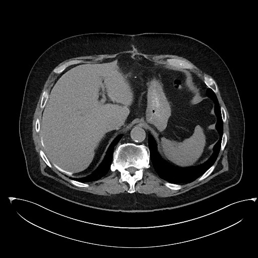 File:Buried bumper syndrome - gastrostomy tube (Radiopaedia 63843-72577 Axial Inject 20).jpg