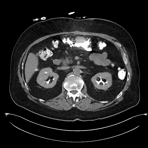 Buried bumper syndrome - gastrostomy tube (Radiopaedia 63843-72577 Axial Inject 37).jpg