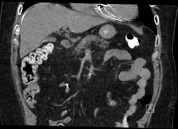 Buried bumper syndrome - gastrostomy tube (Radiopaedia 63843-72577 Coronal Inject 54).jpg