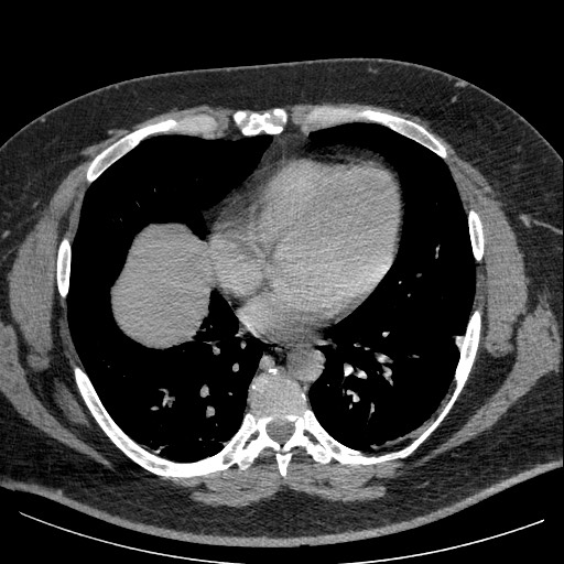File:Burned-out testicular seminoma - retroperitoneal nodal metastases (Radiopaedia 62872-71245 A 3).jpg