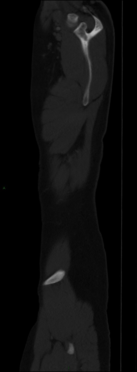 Burst fracture (Radiopaedia 83168-97542 Sagittal bone window 113).jpg
