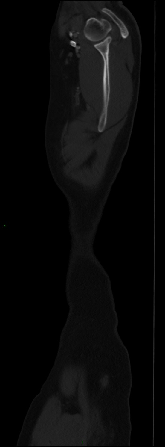 Burst fracture (Radiopaedia 83168-97542 Sagittal bone window 18).jpg