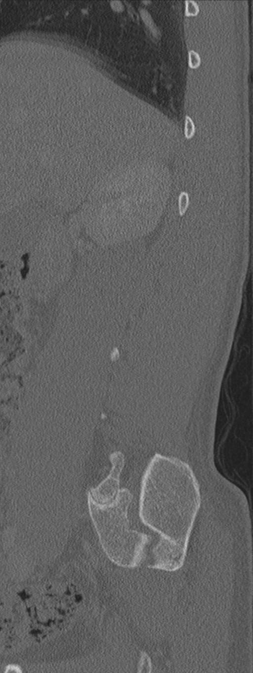 Burst fracture - T12 with conus compression (Radiopaedia 56825-63647 Sagittal bone window 73).png