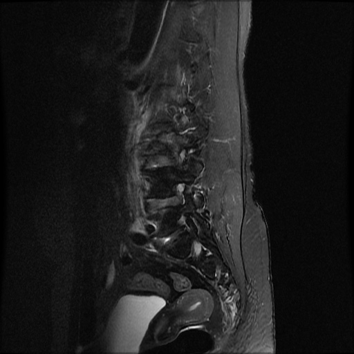 File:Burst fracture - lumbar spine (Radiopaedia 72877-83541 Sagittal STIR 9).jpg