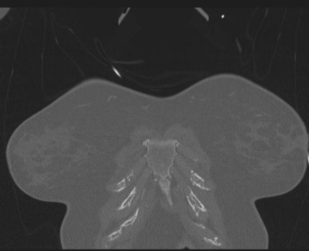 Burst fracture - thoracic spine (Radiopaedia 30238-30865 Coronal bone window 18).jpg