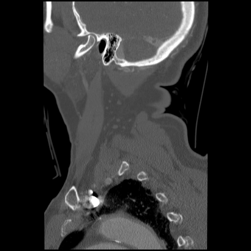 File:C1 anterior arch (plough) fracture - type 1 (Radiopaedia 76181-87720 Sagittal bone window 21).jpg