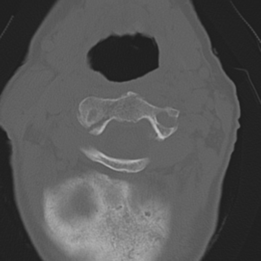File:C2 fracture with vertebral artery dissection (Radiopaedia 37378-39199 Axial bone window 17).png