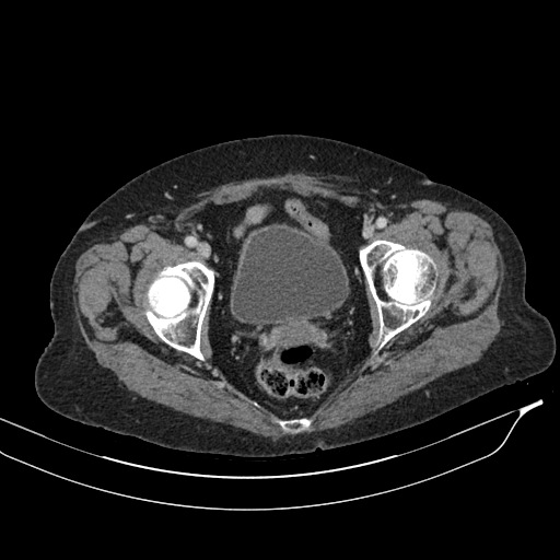 Calcified adrenal glands and Spigelian hernia (Radiopaedia 49741-54988 A 223).jpg