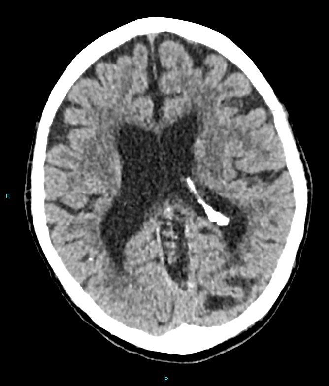 Calcified cerebral emboli from left ventricular thrombus (Radiopaedia 84420-99758 Axial non-contrast 44).jpg
