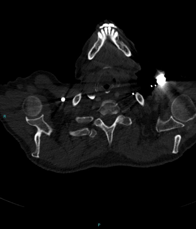 Calcified cerebral emboli from left ventricular thrombus (Radiopaedia 84420-99760 Axial bone window 1).jpg
