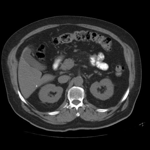 File:Calcified hepatic hydatid cyst (Radiopaedia 18907-18853 Axial non-contrast 21).jpg