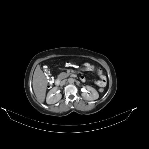 File:Calcified hydatid cyst of the liver (Radiopaedia 21212-21112 Axial C+ delayed 22).jpg