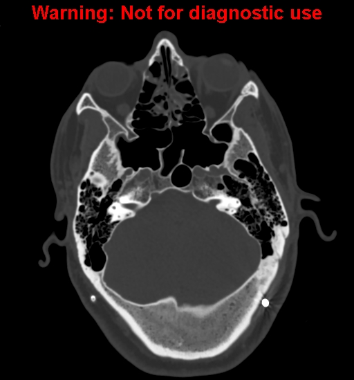 File:Calvarial thickening from chronic shunting (Radiopaedia 60079-67637 Axial bone window 44).jpg