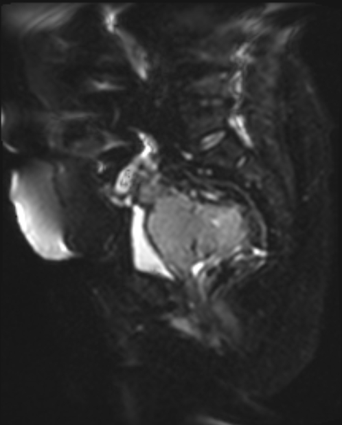 Cancer cervix - stage IIb (Radiopaedia 75411-86615 Sagittal DWI 12).jpg