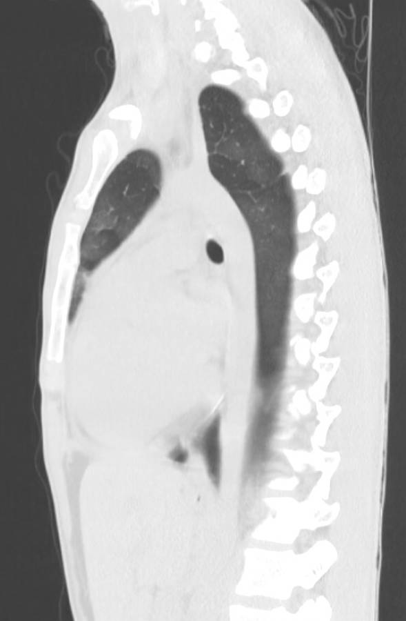 Cannabis-induced diffuse alveolar hemorrhage (Radiopaedia 89834-106946 Sagittal lung window 77).jpg
