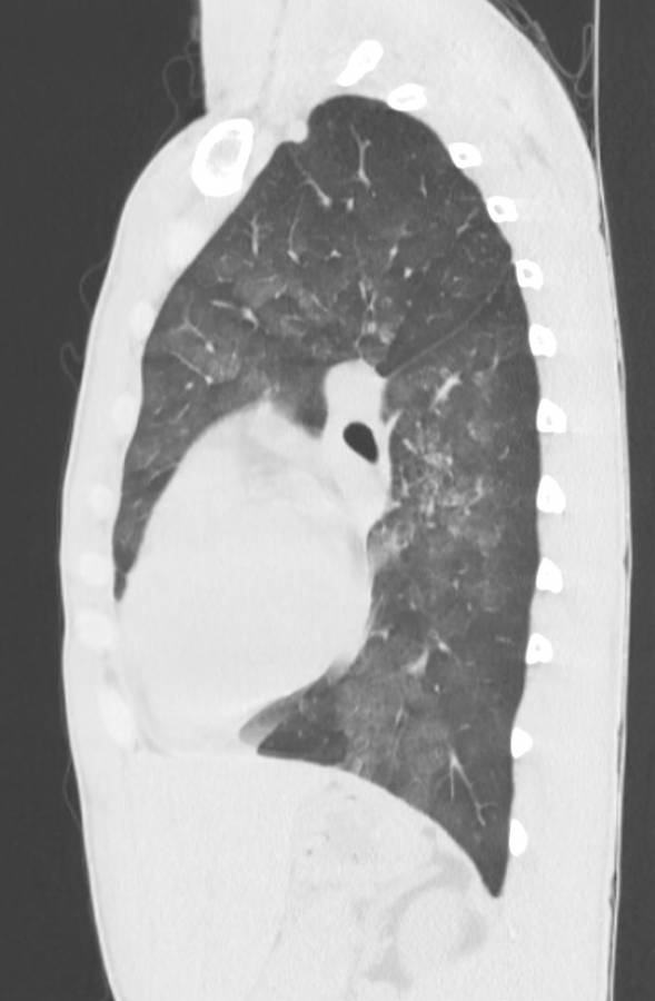 Cannabis-induced diffuse alveolar hemorrhage (Radiopaedia 89834-106946 Sagittal lung window 88).jpg