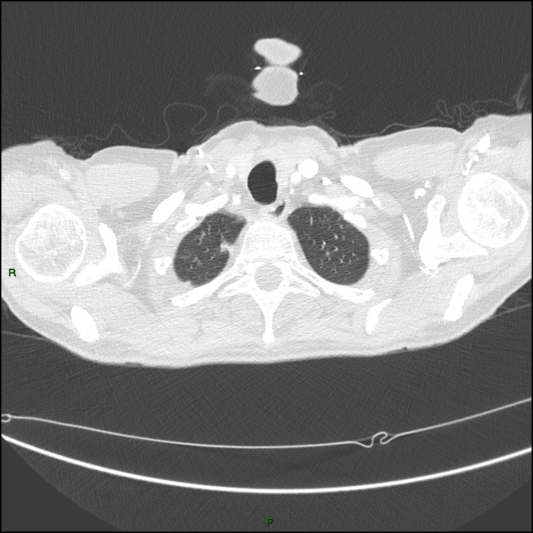 Cannonball metastases (Radiopaedia 82110-96150 Axial lung window 25).jpg