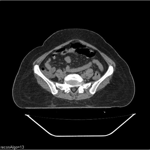 Carcinoma cervix- brachytherapy applicator (Radiopaedia 33135-34173 Axial non-contrast 4).jpg