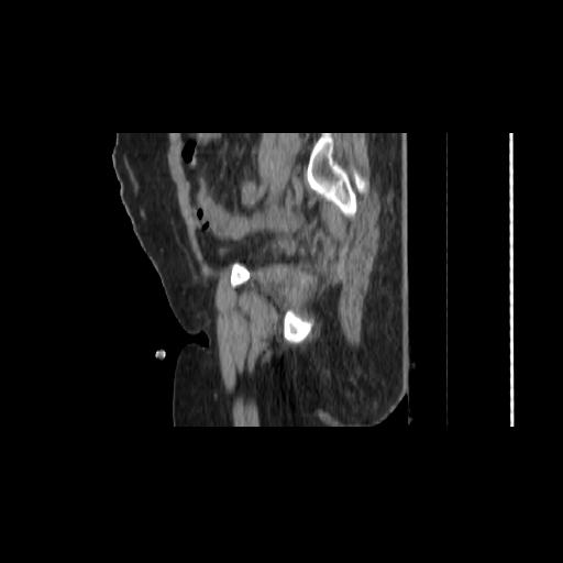 File:Carcinoma cervix- brachytherapy applicator (Radiopaedia 33135-34173 D 45).jpg