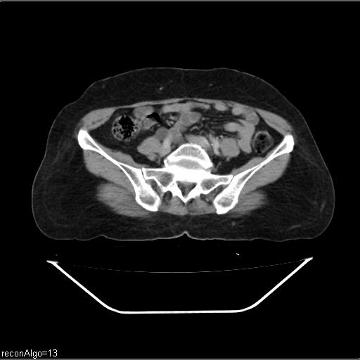 Carcinoma cervix- recurrence (Radiopaedia 34702-36137 B 37).jpg