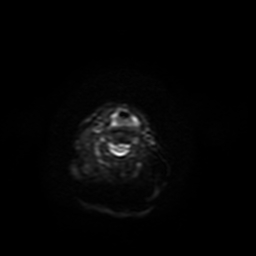 File:Carcinoma ex-pleomorphic adenoma of parotid (Radiopaedia 28383-28627 Ax DWI B-500 GE 2).jpg