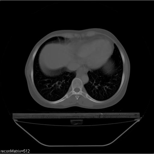 File:Carcinoma of esophagus (Radiopaedia 27356-27550 Axial bone window 11).jpg