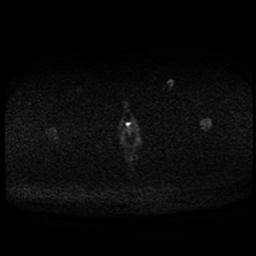 Carcinoma of the cervix (Radiopaedia 89018-105858 Axial DWI 43).jpg