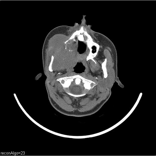 Carcinoma of the maxillary antrum (Radiopaedia 53805-59888 Axial non-contrast 54).jpg