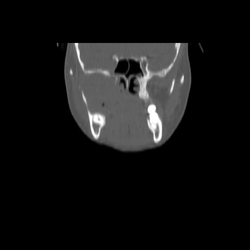 Carcinoma of the maxillary antrum (Radiopaedia 53805-59888 Coronal bone window 56).jpg