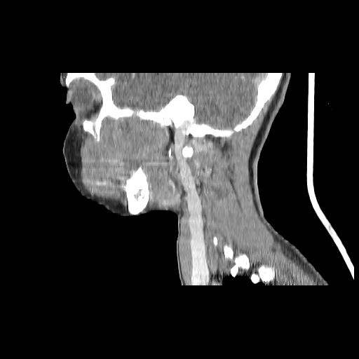 Carcinoma of the maxillary antrum (Radiopaedia 53805-59888 Sagittal C+ delayed 56).jpg