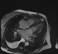 File:Cardiac amyloidosis (Radiopaedia 51404-57150 A 10).jpg