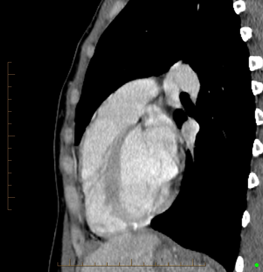 Cardiac paraganglioma (Radiopaedia 76345-88005 C 35).jpg