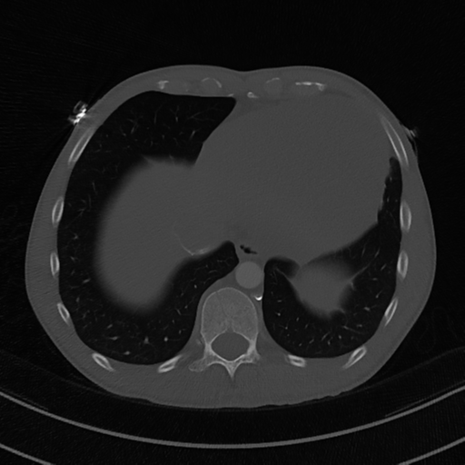 Cardiac tumor - undifferentiated pleomorphic sarcoma (Radiopaedia 45844-50134 Axial bone window 56).png