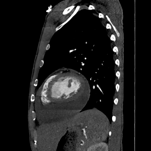 Cardiac tumor - undifferentiated pleomorphic sarcoma (Radiopaedia 45844-50134 B 18).png