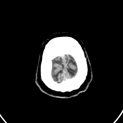 Cardioembolic stroke- ACA and MCA territories (Radiopaedia 58904-66140 Axial non-contrast 161).jpg