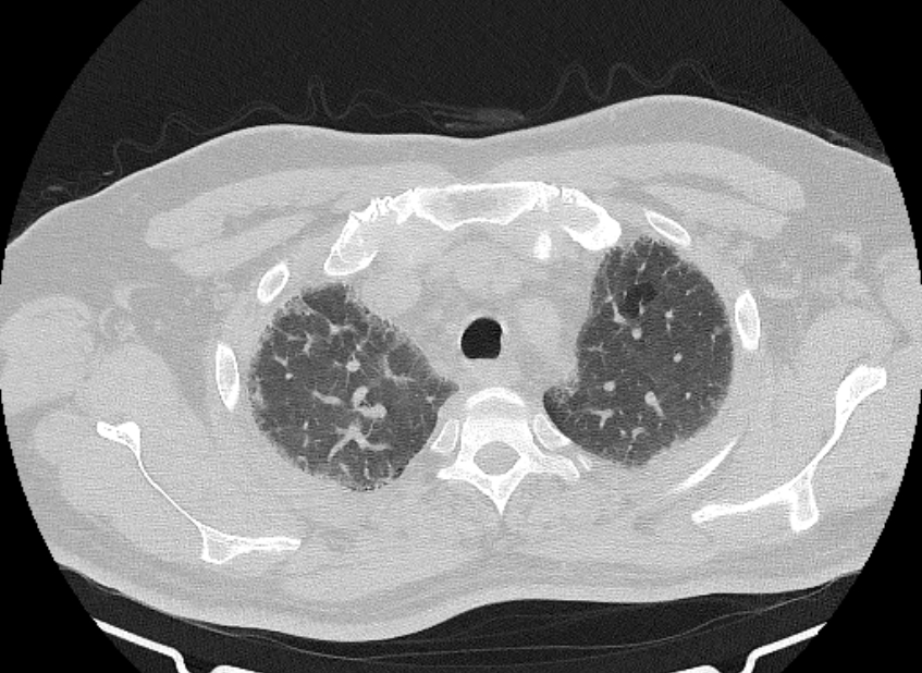 Cardiogenic pulmonary edema (Radiopaedia 68180-77678 Axial lung window 14).jpg