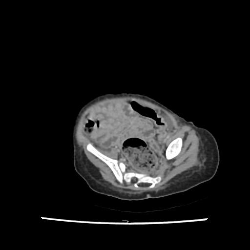 Caroli disease with autosomal recessive polycystic kidney disease (ARPKD) (Radiopaedia 89651-106703 B 190).jpg