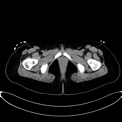 Caroli disease with medullary sponge kidney (Radiopaedia 82622-96804 Axial non-contrast 79).jpg