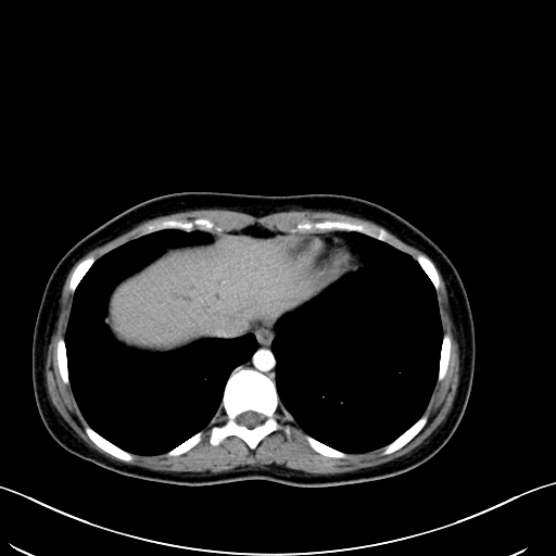 Caroli disease with medullary sponge kidney (Radiopaedia 82622-96804 C 12).jpg