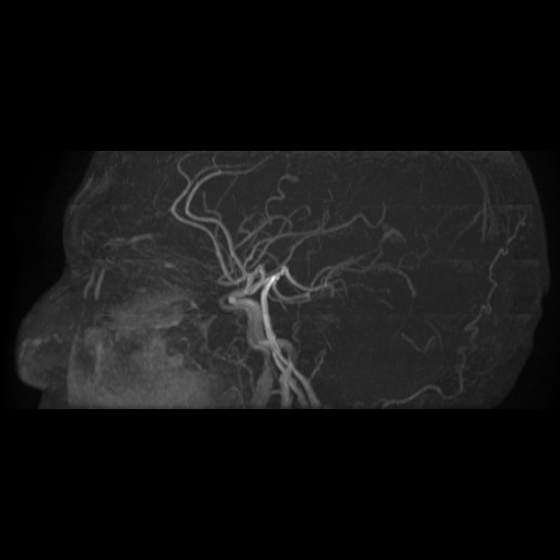 File:Carotid arterial dissection with acute cerebral infarction (Radiopaedia 26636-26784 MRA 3).jpg