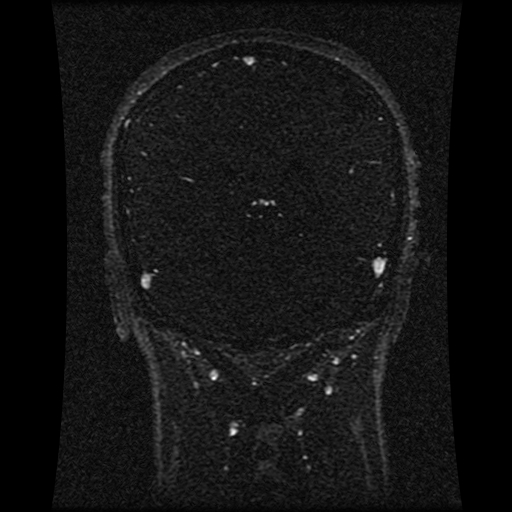 Carotid arterial dissection with acute cerebral infarction (Radiopaedia 26636-26784 MRV 72).jpg
