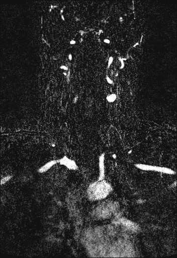 Carotid artery dissection (Radiopaedia 28441-28689 Coronal MRA 43).jpg