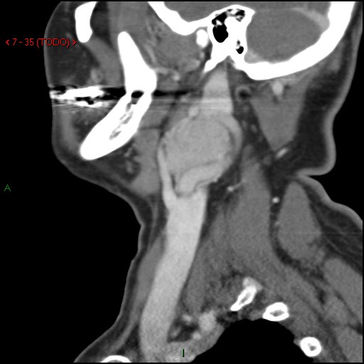 File:Carotid body tumor (Radiopaedia 20564-20462 E 1).jpg